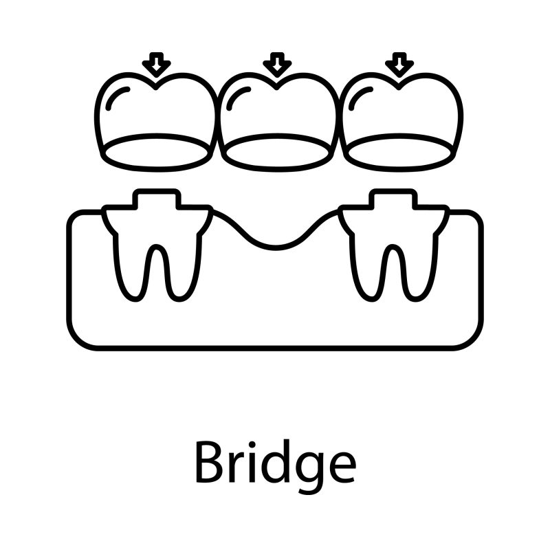Dental bridge illustration