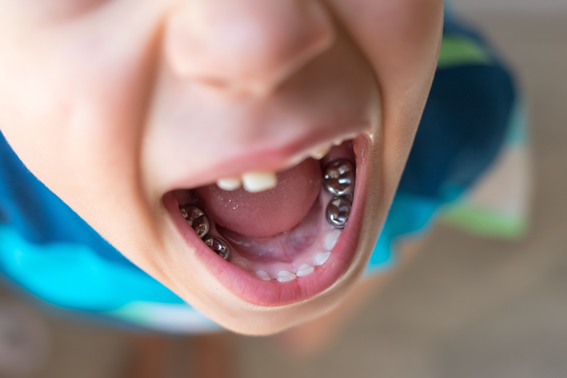 Child opening their mouth and showing stainless steel crowns